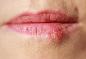 Pimple on Your Lip